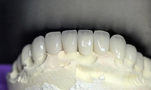 Zirconia in Dentistry-Everything you need to know about Multilayer zirconia